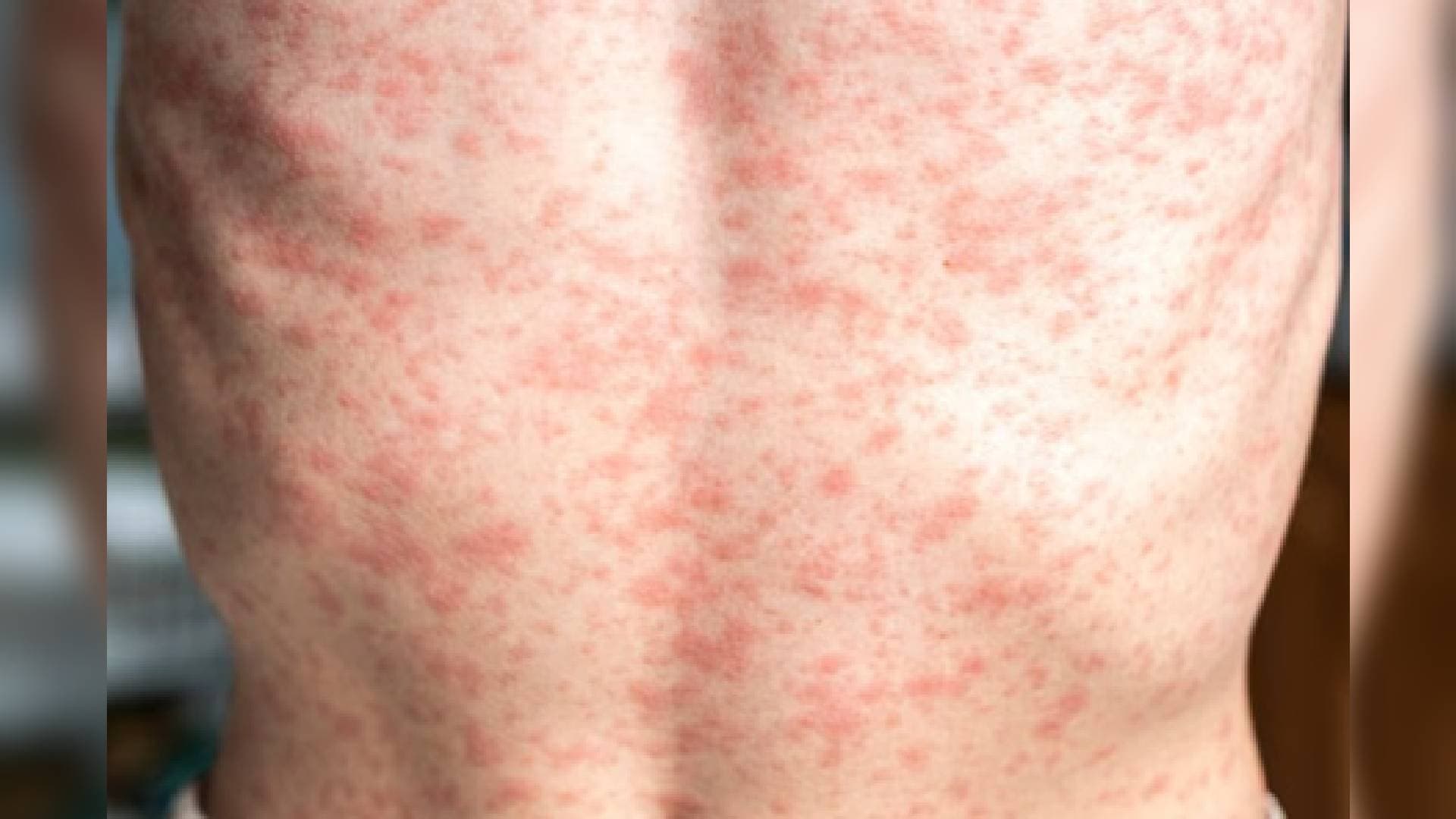 Third Measles Death Reported In US; Kennedy Visits West Texas Amid Rising Cases