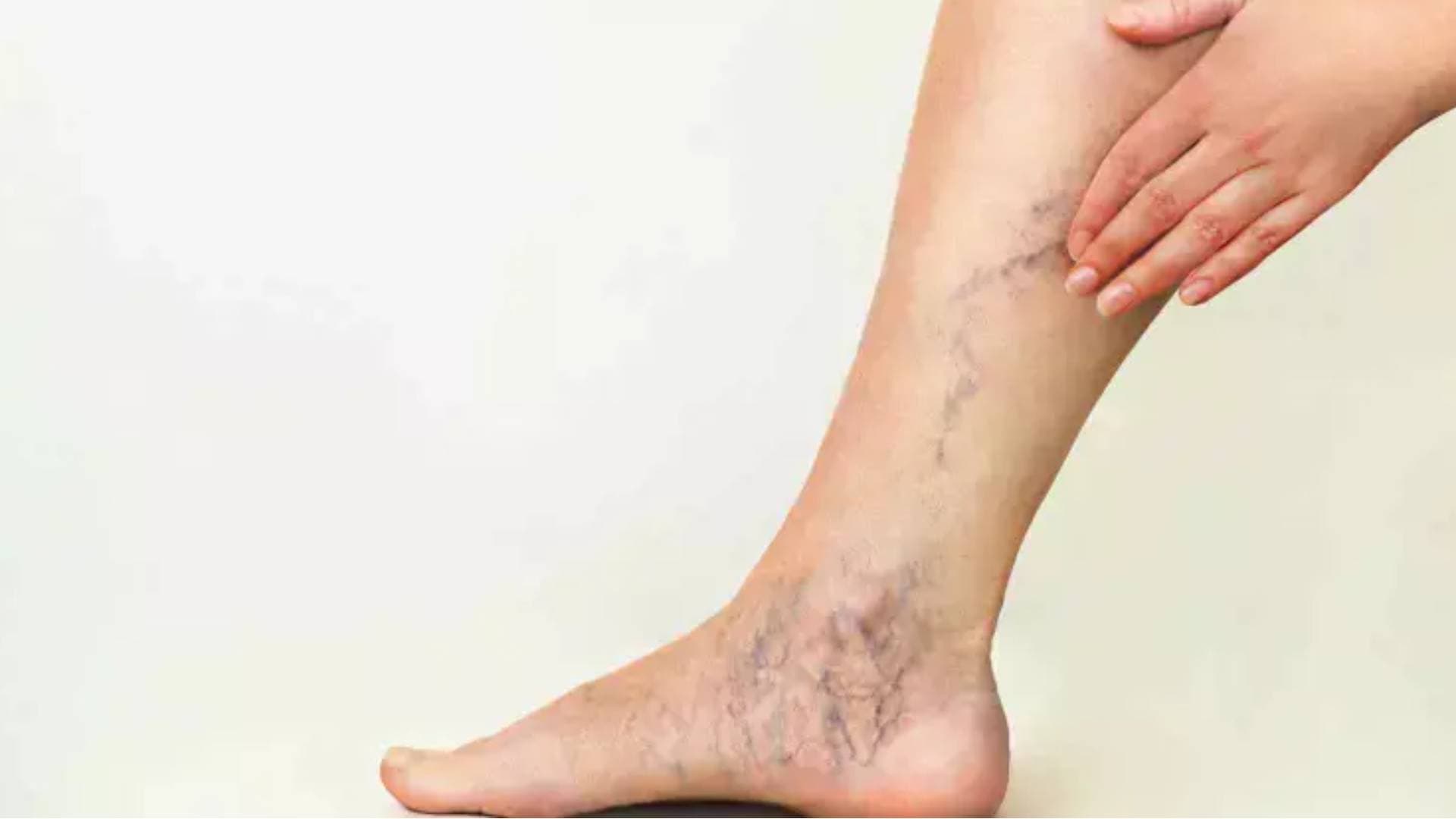 Ice-Cold Feet And Heaviness In Legs? It May Signal Varicose Veins, Says Study