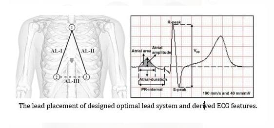 NIT Rourkela Designs Breakthrough ECG Lead System For Enhanced Diagnosis Of Atrial Arrhythmias
