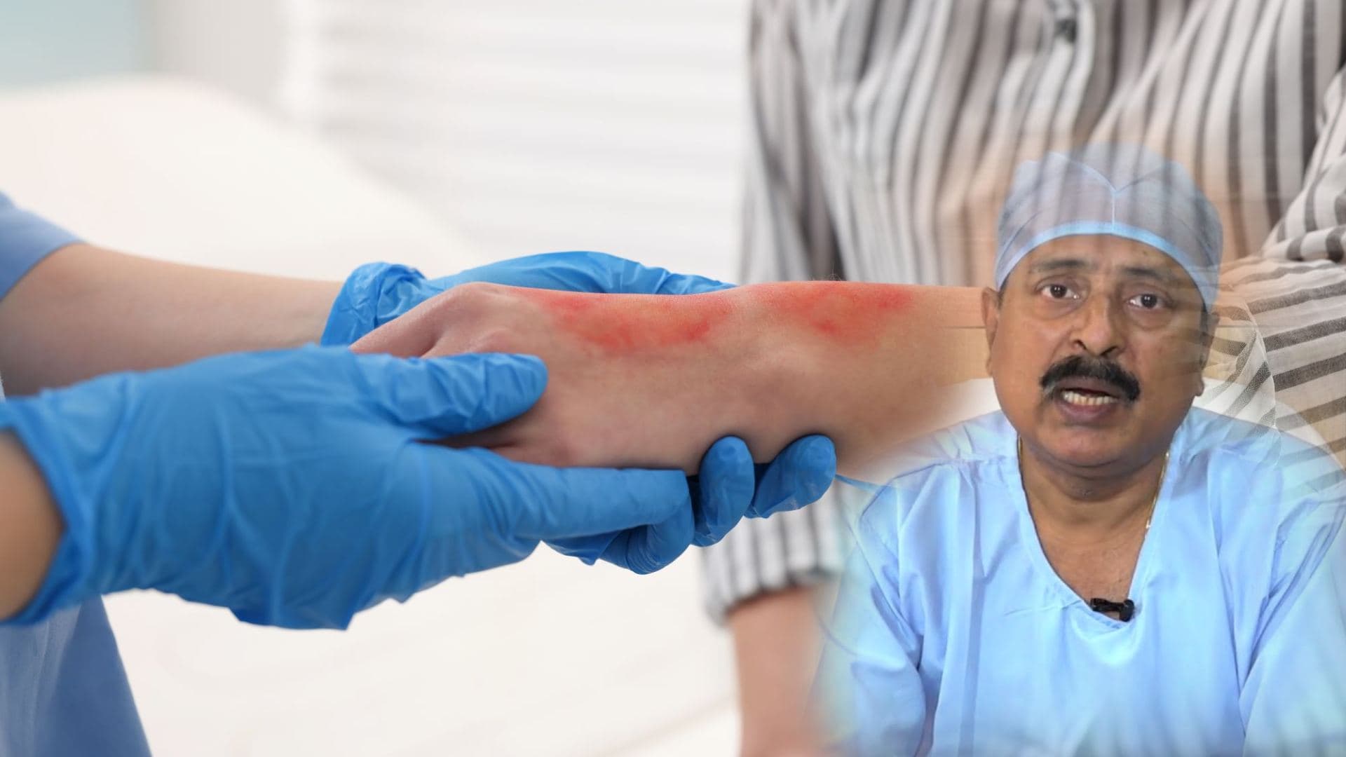 Skin Transplants and Survival: What You Need to Know About Burn Injuries