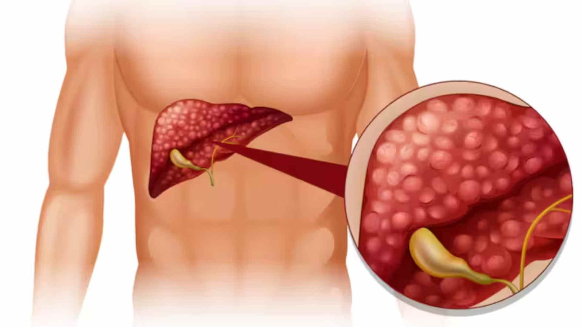Indian Scientists Develop New Approach For Treatment Of Liver Cirrhosis