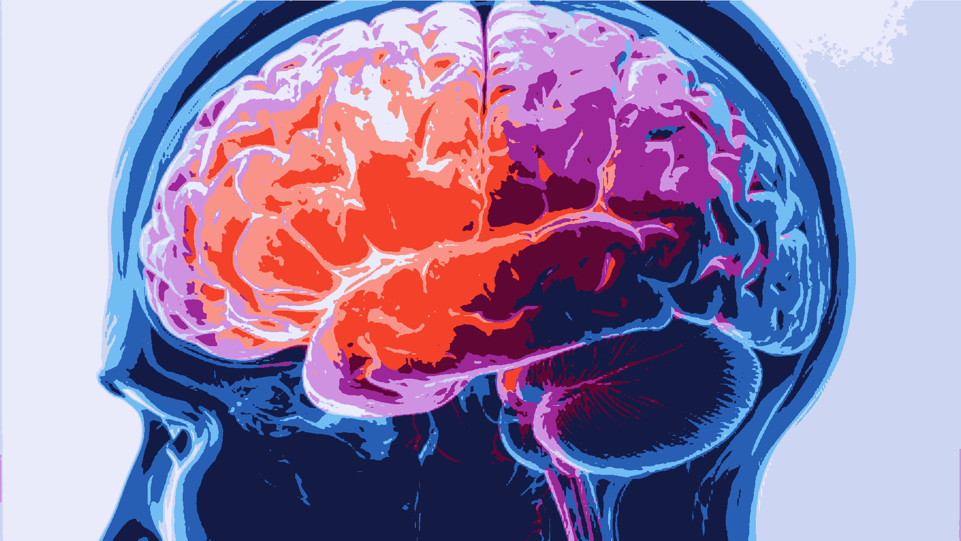 Deadly Brain Cancer Can Alter Skull, Immune Response: Study