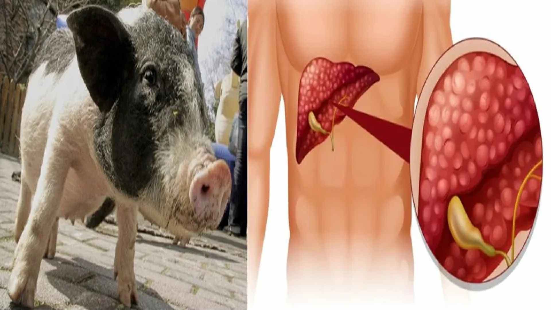 China Pushes Boundaries With First Pig-To-Human Liver Graft: What’s Next?