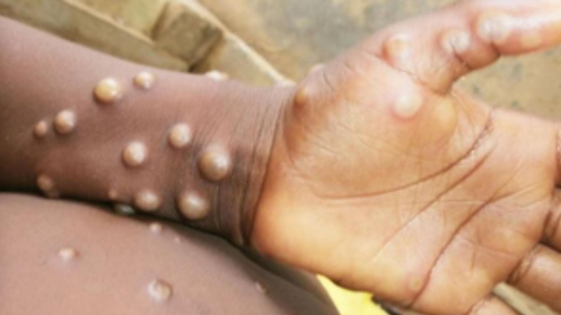 Sweden Reports 1st Case Of More Infectious Mpox Variant Outside Africa