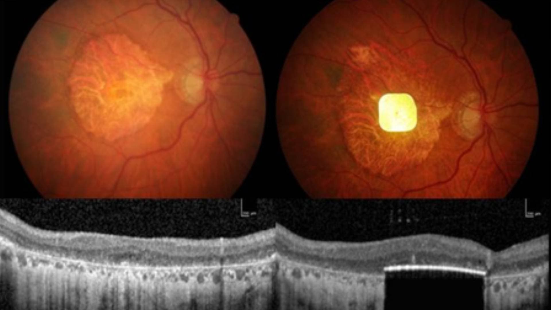 New Retinal Implant Restores Vision In Patients With Irreversible Blindness