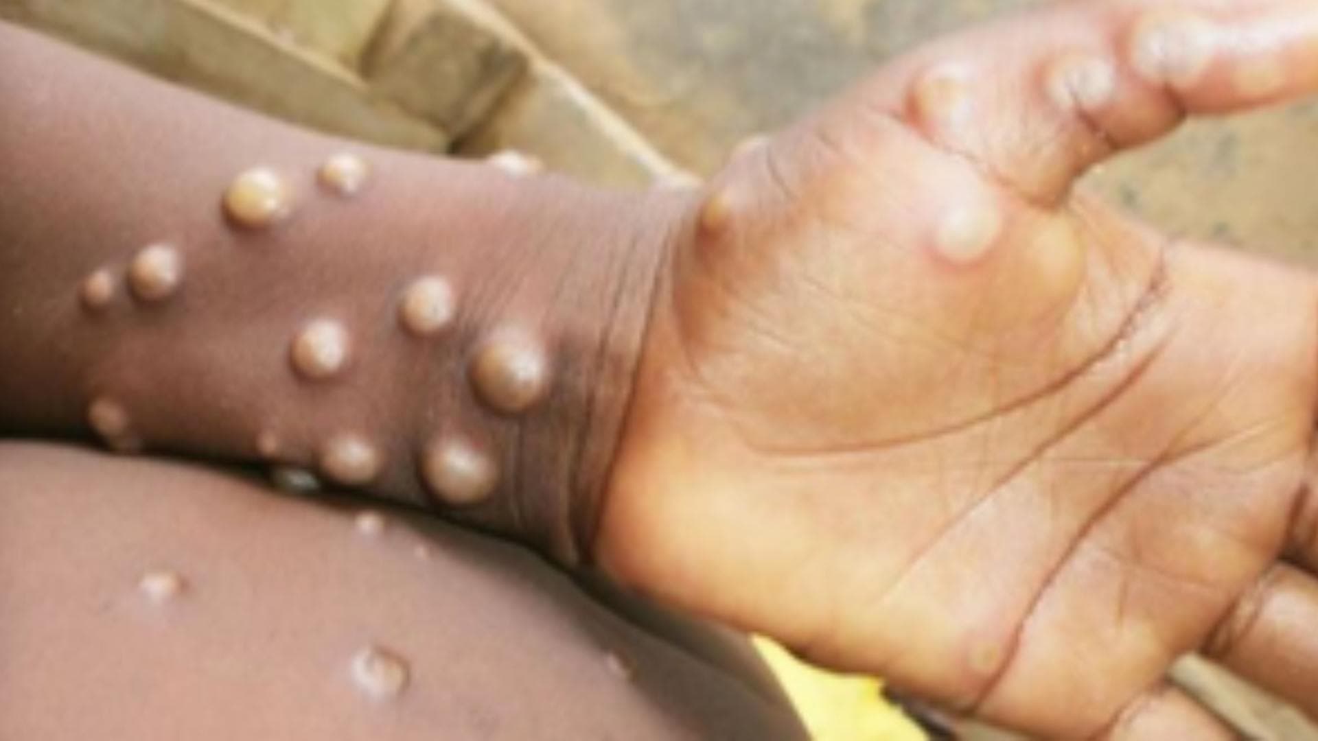 WHO declares global health emergency over Mpox outbreak